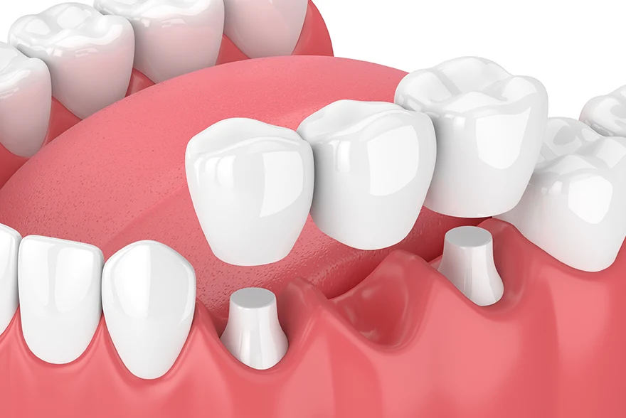Dental Bridges Jacksonville