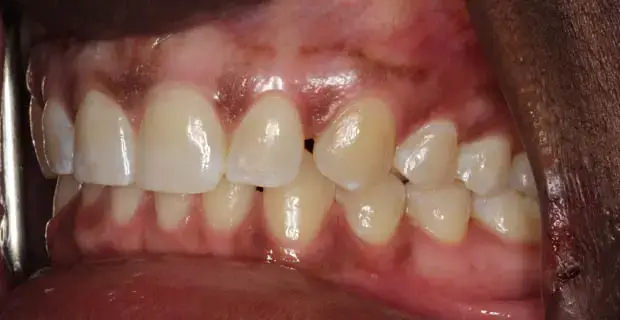 Cosmetic Makeover After - Patient 1