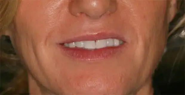 Cosmetic Makeover Before - Patient 2