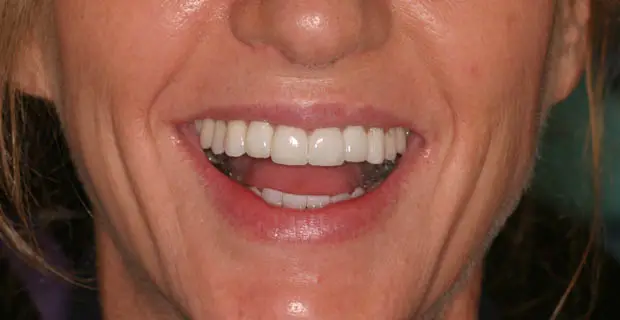 Cosmetic Makeover After - Patient 2