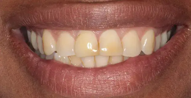 Stained Teeth Before - Patient 1