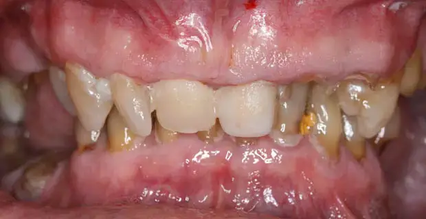 implants1a