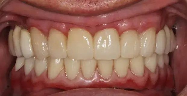 implants1b