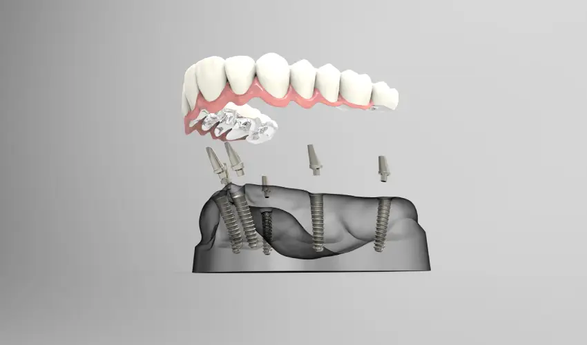 all-on-6 implants jacksonville