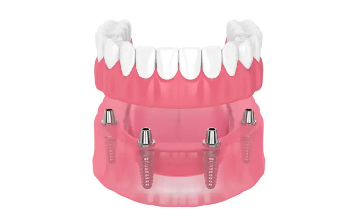 A 3D representation of Snap on Dentures in Jacksonville, FL