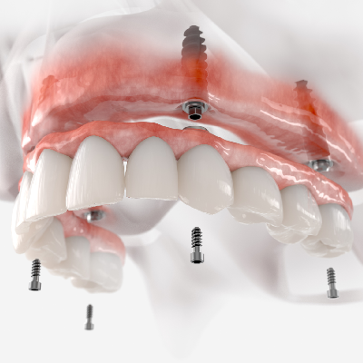 What Is All-on-4 Dental Implants_