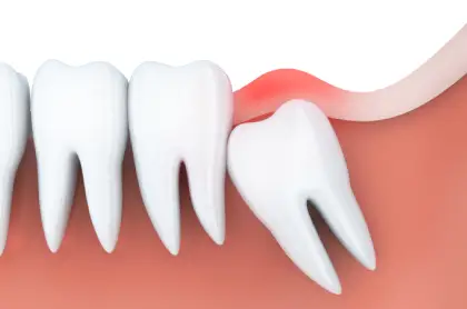 Does Wisdom Teeth Removal Hurt?