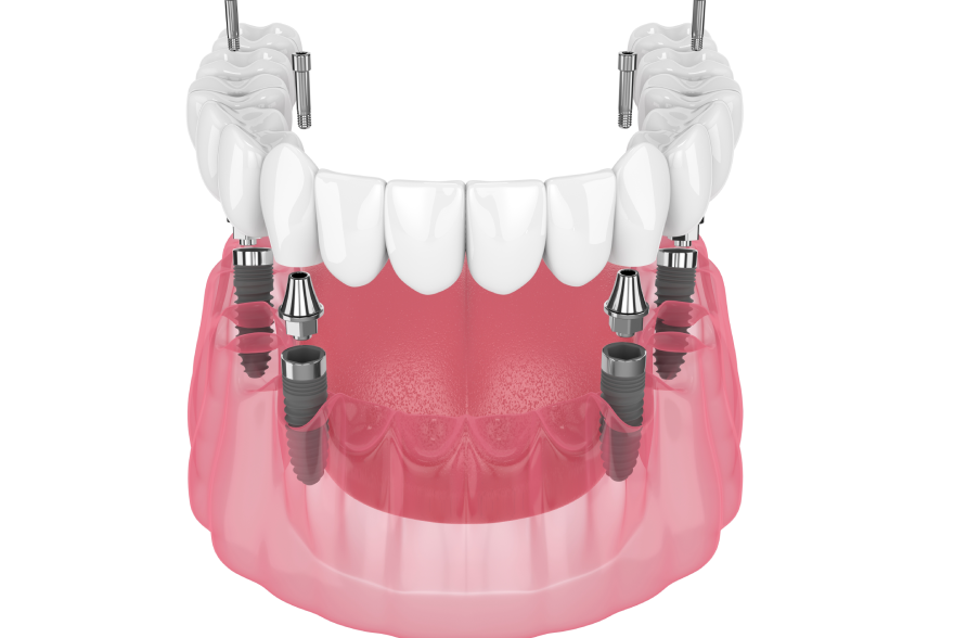 All-on-4 Dental Implants in Jacksonville, FL