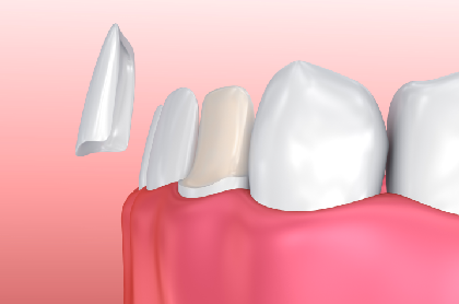 Are Veneers Permanent?