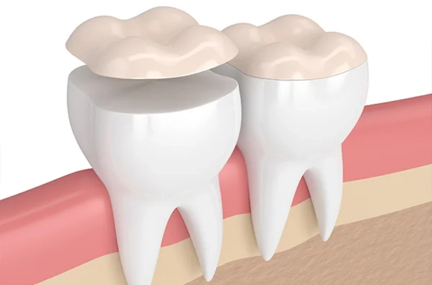 Dental Inlays and Onlays in Jacksonville, FL