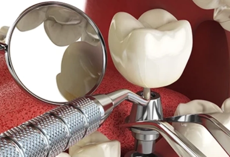 Mini Dental Implants in Jacksonville, FL